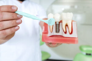 , Dental Implants in the UK vs. Abroad: Making Informed Choices for Your Smile – Hallcross Dental Leicester
